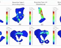 Characteristics and advantages of 3D printing medical prosthesis after reconstruction of pelvic defects￼