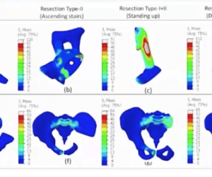 Characteristics and advantages of 3D printing medical prosthesis