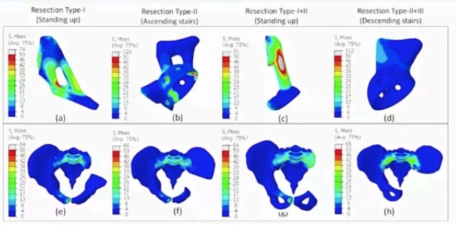 Characteristics and advantages of 3D printing medical prosthesis after reconstruction of pelvic defects