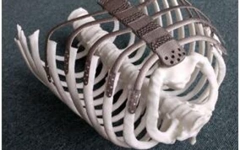 3D Printing Cervical Spine: Revolutionizing Medical Implants