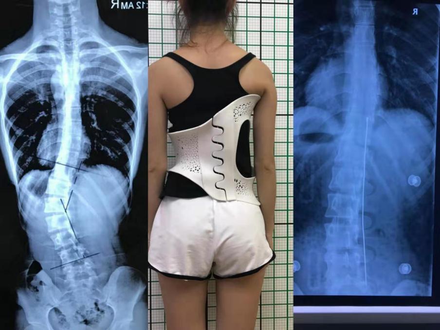 3D scanning and 3D printing technologies support orthopaedic brace customisation