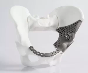 Orthopedic Additive Manufacturing: Benefits and Challenges
